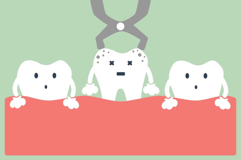 Three cartoon teeth with the middle tooth being extracted by dental forceps.